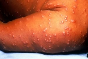 small pox homeopathic treatment in hindi