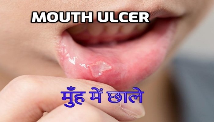 mouth ulcer home remedy