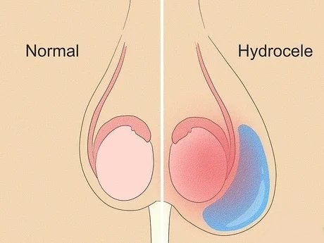 hydrocele homeopathic treatment in hindi